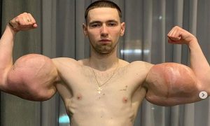 روسی نوجوان نے بازوں انجیکشن سے پھلا لیے