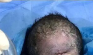 عراق، ایک آنکھ والے بچے کی پیدائش، تصاویر سوشل میڈیا پر وائرل