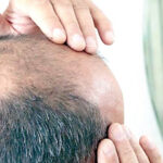 baldness