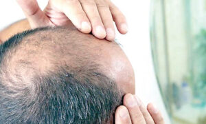 baldness