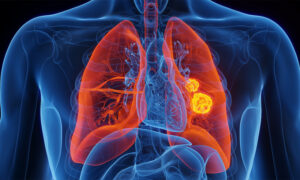 پھیپھڑوں کے کینسر کی اصل وجہ سامنے آ گئی، نئی تحقیق نے چونکا دیا