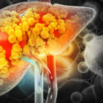 جگر کی چربی کم کرنے کے آسان اور مؤثر طریقے