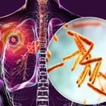 ٹی بی سے متاثرہ ممالک کی فہرست جاری؛ پاکستان کس نمبر پر؟