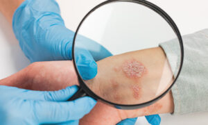 جلد کا کینسر: علامات، خطرات اور بچاؤ کے طریقے