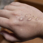 منکی پاکس کے نئے کیسز رپورٹ