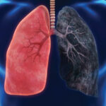 پھیپھڑوں کے کینسر کی ابتدائی علامات پیروں میں بھی ظاہر ہو سکتی ہیں، ماہرین کی وارننگ