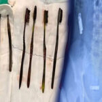 حیران کن سرجری، نوجوان کے معدے میں خطرناک اشیا نکل آئیں