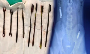 حیران کن سرجری، نوجوان کے معدے میں خطرناک اشیا نکل آئیں